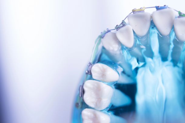 close up of braces on teeth model to straighten teeth
