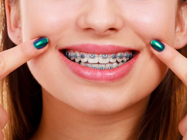 girl smiling and pointing to her braces