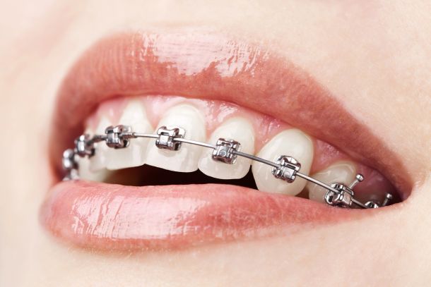 close up of woman's smile with braces