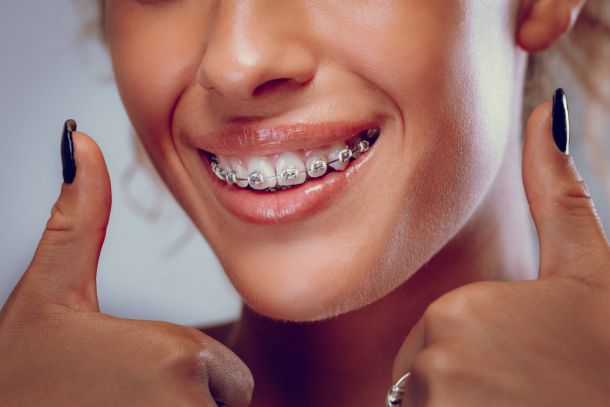 close up of woman's clear bracket braces, smiling, holding two thumbs up