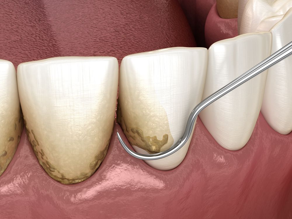 dental tool removing plaque between teeth