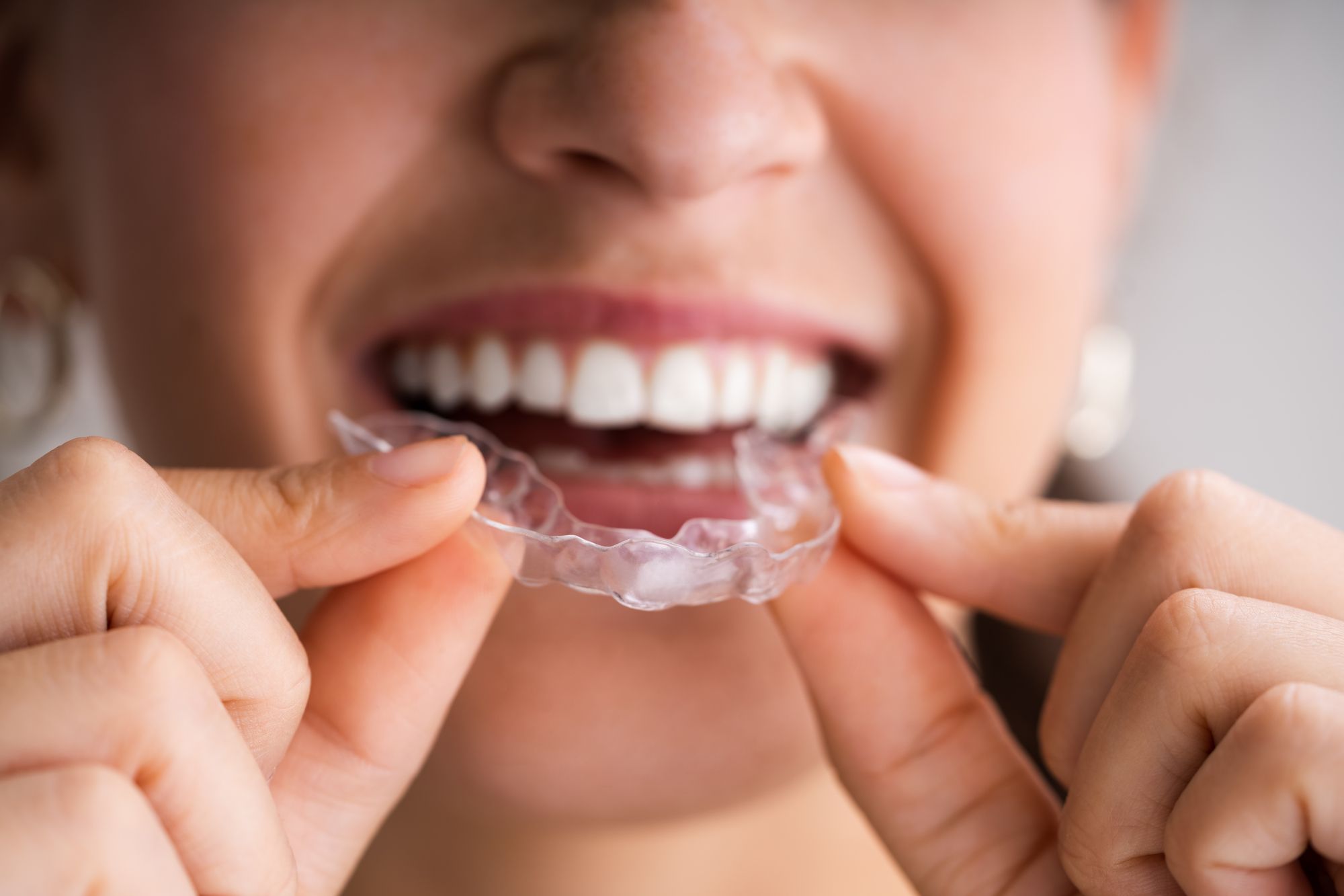 close up of woman putting Invisalign clear aligner in her mouth