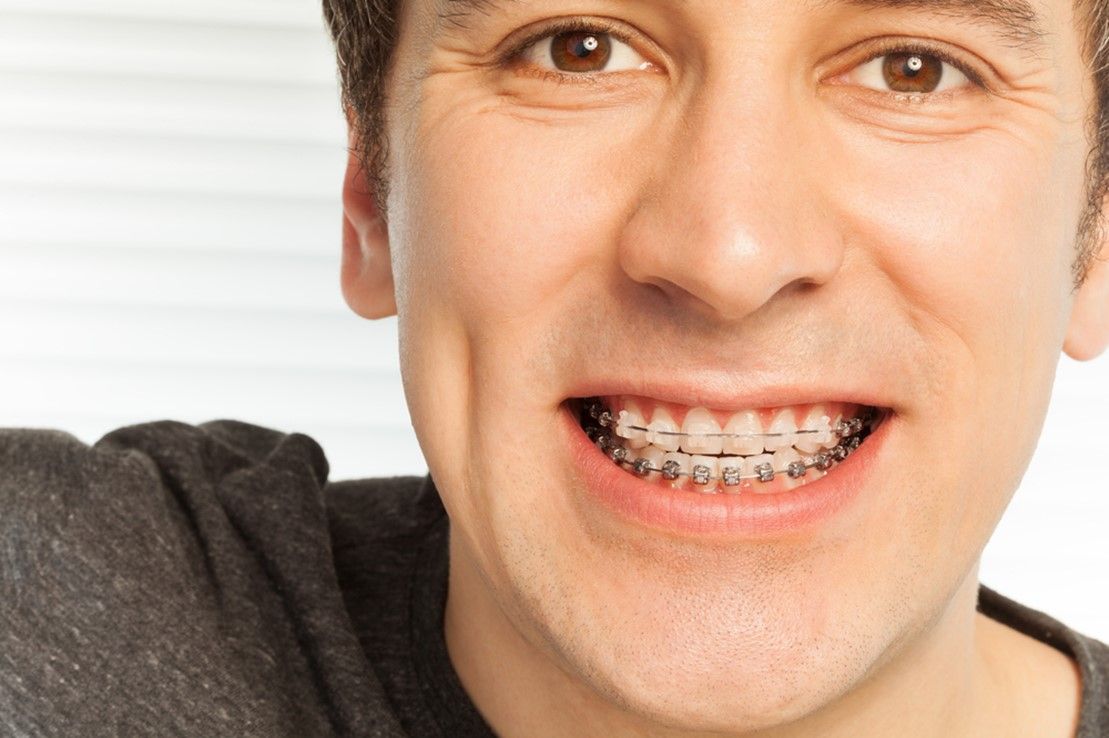 man wearing metal braces to straighten teeth