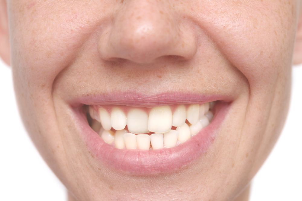 young woman with crooked teeth needs braces