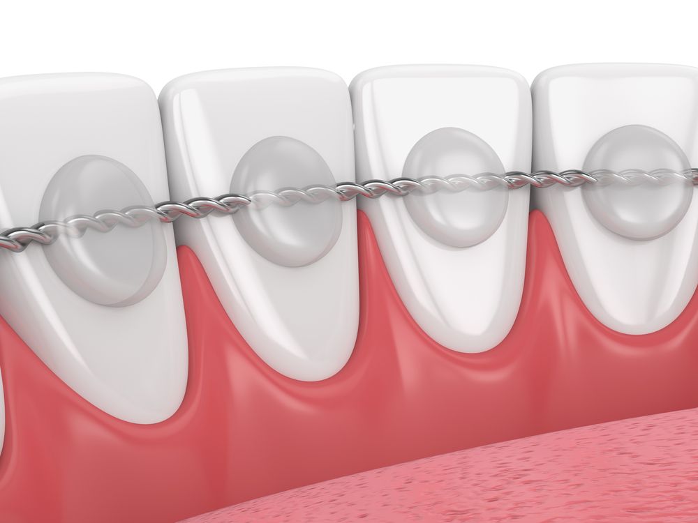 bonded or fixed retainer across lingual surfaces of lower teeth