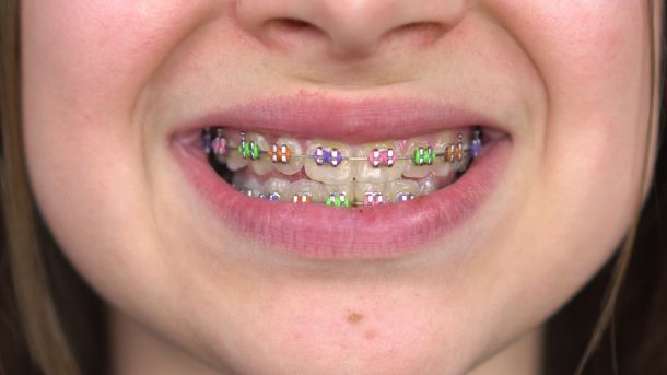 multi-colored braces bracket bands on teen girl