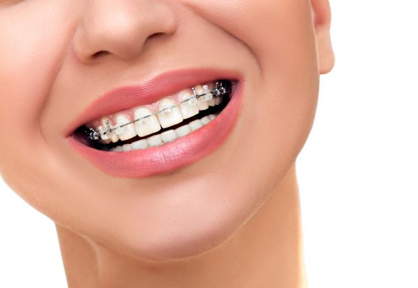 woman smile with clear or ceramic braces brackets