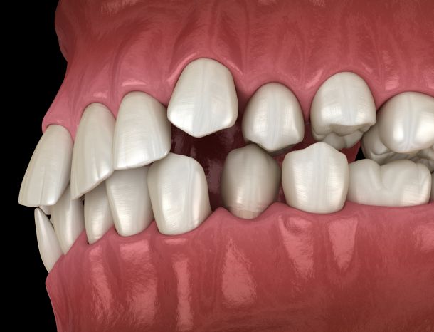 Crooked teeth position, orthodontic concept. Medically accurate tooth 3D illustration