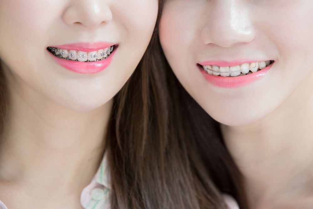 two teen girls with orthodontic braces and retainer