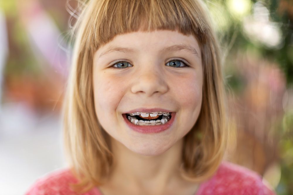 6 Year Old Girl with Phase 1 Orthodontics Braces