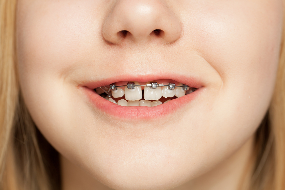 child wearing braces