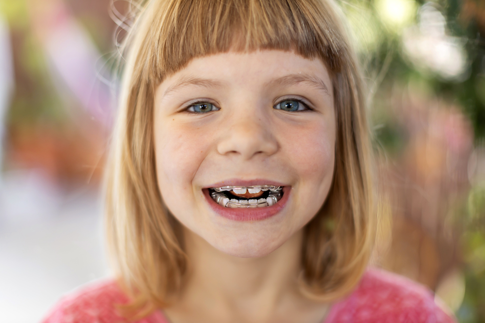 6 Year Old Girl with Phase 1 Orthodontics Braces