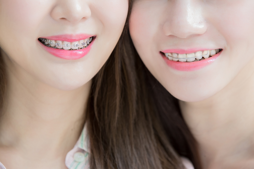 two teen girls with orthodontic braces and retainer
