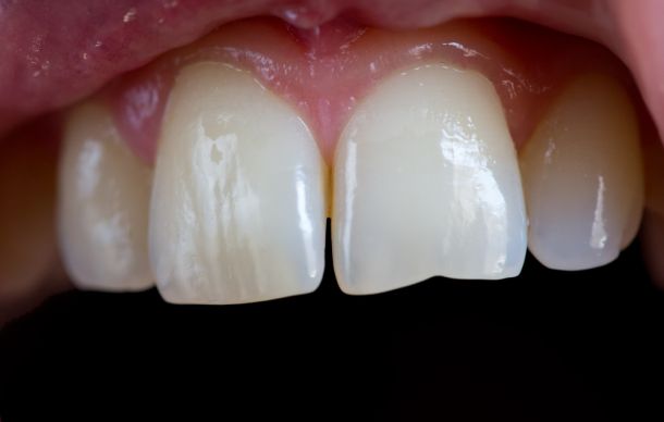 two front teeth are uneven