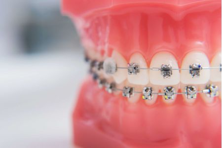 metal braces shown on a model of a mouth