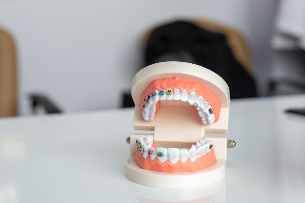model of the mouth with clear braces and metal braces with colorful bands