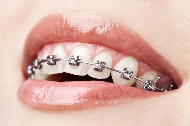 close up of woman's smile with braces