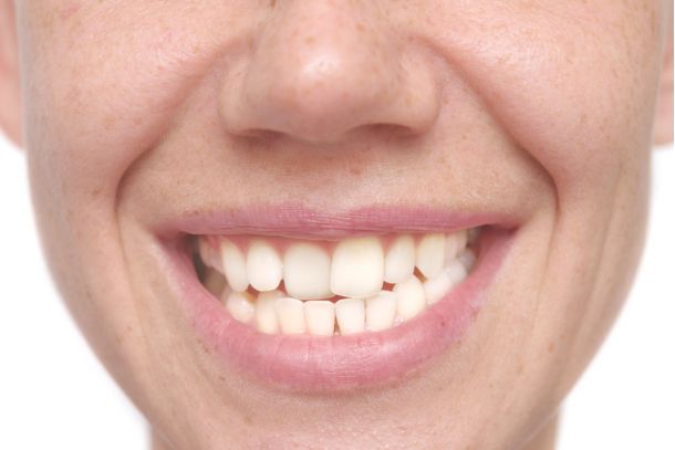 young woman with crooked teeth needs braces
