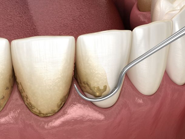 dental tool removing plaque between teeth